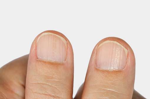 Cosa significano le unghie con le sbavature?